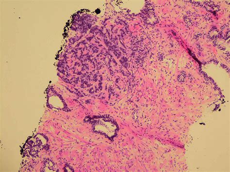 Cureus Small Cell Carcinoma Of The Prostate A Case Report And Review