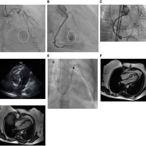 Fluoroscopic Images Of The Septal Haematoma A Initial Septal