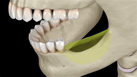 Laser Gum Surgery In Sacramento Ca Tooth And Bone Loss