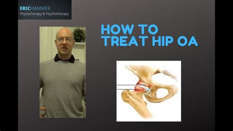 How To Treat Hip Arthritis Youtube