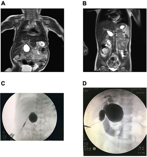 Frontiers Comparative Analysis Of Cystic Biliary Atresia And Choledochal Cysts
