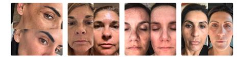 Musely Spot Cream Review Does It Work For Melasma Fin Vs Fin