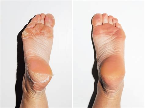 Foot Peel Foot Care Tips