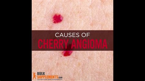 Cherry Angioma Cherry Angioma Removal Cherry Angioma Causes Youtube