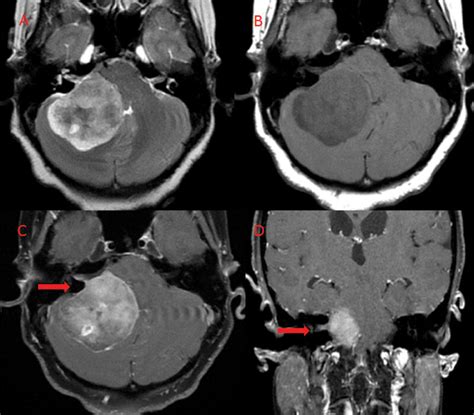 Preoperative Magnetic Resonance Imaging Mri A Axial T2 Weighted Mr