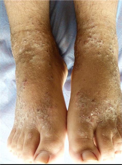 Dermatitis On Feet