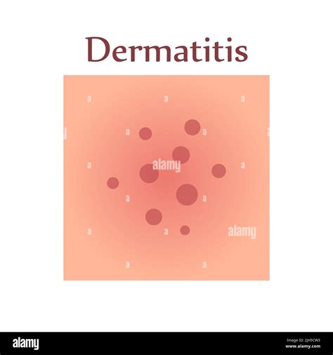 Dermatitis De La Piel Humana Enfermedad Dermatológica El Síntoma Es