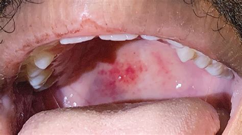 Case 31 2021 A 21 Year Old Man With Sore Throat Epistaxis And