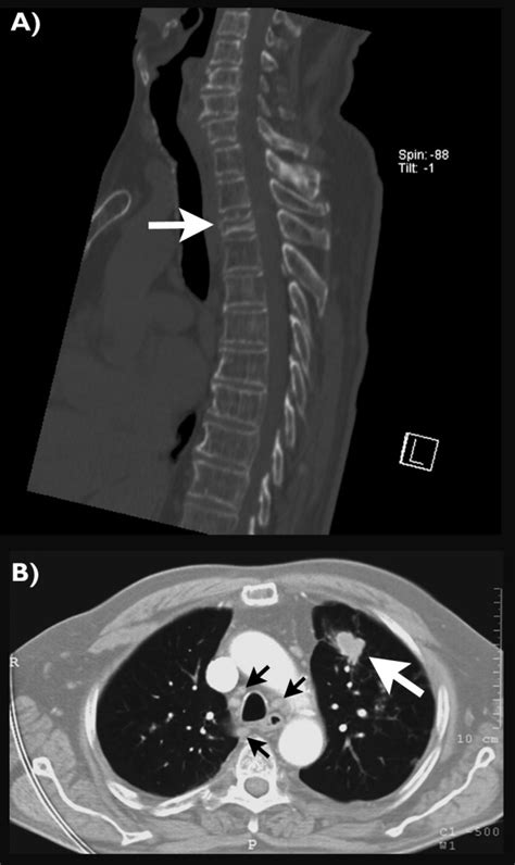 Ct Scans Of The Spine And The Chest The Sagittal Reconstruction Of The
