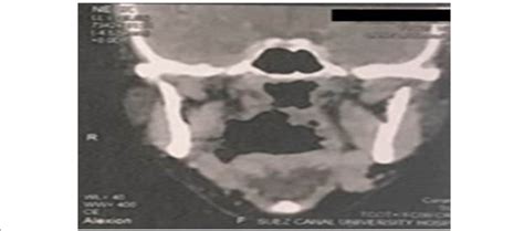 Coronal Ct Showing The Oropharyngeal Defect In The Right Tonsillar Area