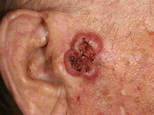 Skin Cancer: Signs, Symptoms, and Complications Skin Cancer  