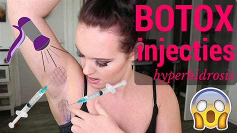 Botox is indicated for the symptomatic treatment of: BOTOX INJECTIES/ HYPERHIDROSIS. Mijn verhaal en ervaringen ...