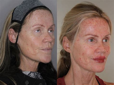 Facial Rejuvenation Before And After Pictures Case 169 Atlanta