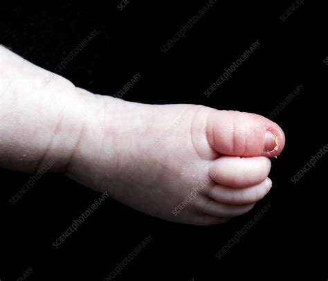 Swollen Toe Stock Image C0238913 Science Photo Library