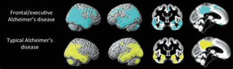 8 Neuroimaging Findings In Dysexecutivefrontal Alzheimers Disease
