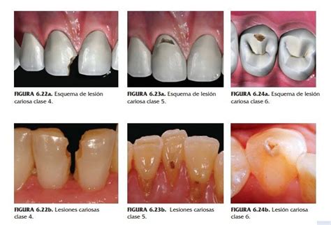 54 Clasificación De Las Lesiones Cariosas Portafolio De Debp Dental