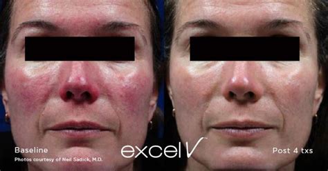 Thread Veins Facial Redness Treatment Royal Tunbridge Wells Uk