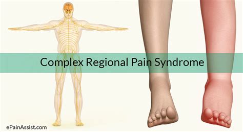 Complex Regional Pain Syndrome Crpstypescausesrisk Factorssigns