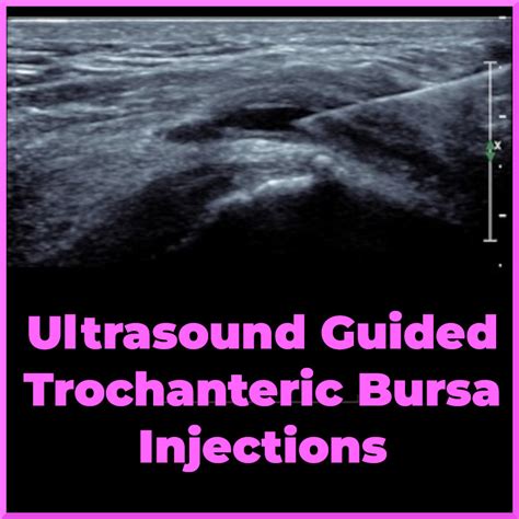 Performing An Ultrasound Guided Trochanteric Bursa Injection Aliconex