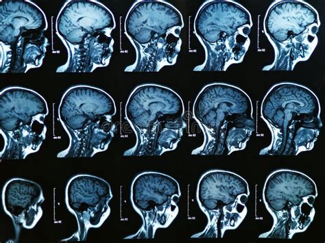 Mri Brain Scan Stock Image Image Of Brain Frontal Cerebellum