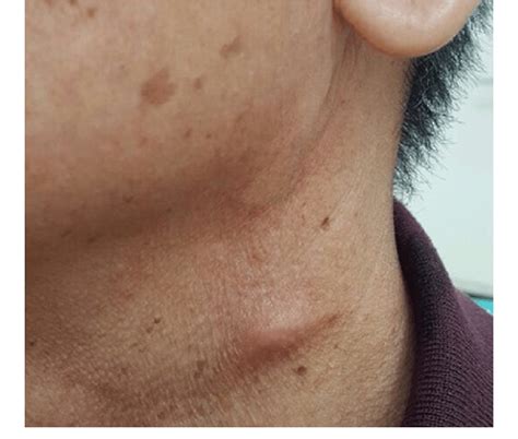 Left Neck Swelling At The Lateral Aspect Of The Neck Download
