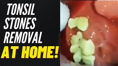 Tonsil Stones Removal Causes And Treatment Youtube