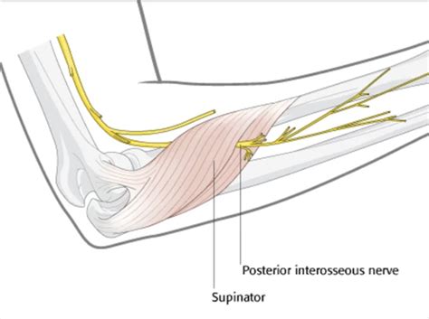 Posterior Interosseous Nerve Injury To The Incarcerated Forearm Dr