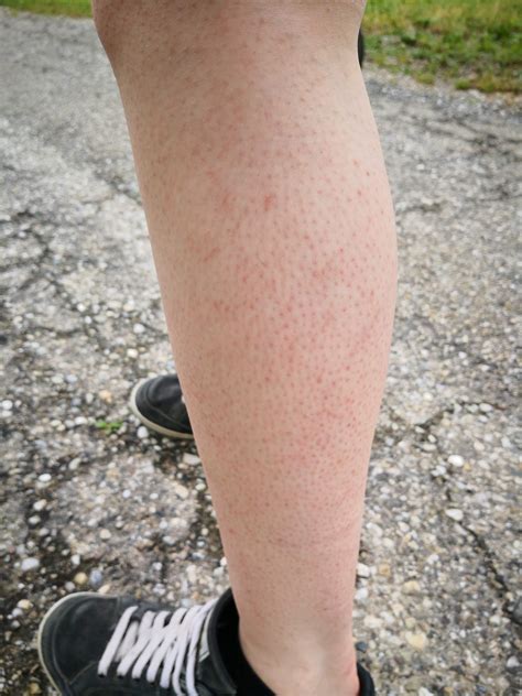 Keratosis Pilarisstrawberry Legs Gesundheit Und Medizin Haare Beauty