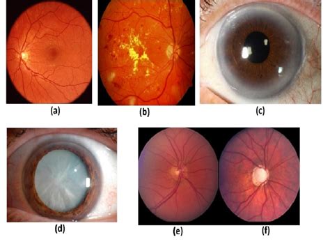 Various Type Of Ocular Diseases Download Scientific Diagram