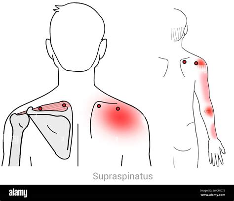 Supraspinatus Myofascial Trigger Points And Associated Pain Locations Stock Photo Alamy