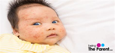 Tinea versicolor, typically known as pityriasis versicolor, is a fungal/yeast skin an infection that. Fungal Skin Infection In Babies - Causes, Symptoms and ...