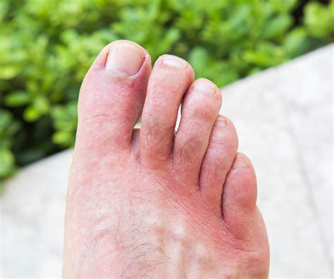 Why Are My Feet Itchy Our Top Tips For Itchy Toes And Feet My Footdr