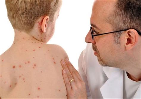 تعرف على مرض الجلد الفقاعي يصيب الأطفال وطبيب يوضح كيف مصراوى
