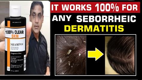 Most Effective Lotion To Treat Seborrheic Dermatitis सबरहइक डरमटइटस क इलज परभव