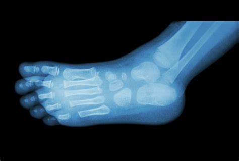 2019 Icd 10 Code For Osteomyelitis Foot