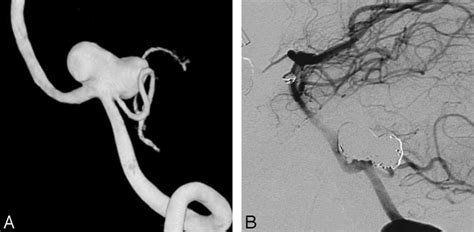 A 52 Year Old Woman With An Incidentally Found Pica Aneurysm A 3d