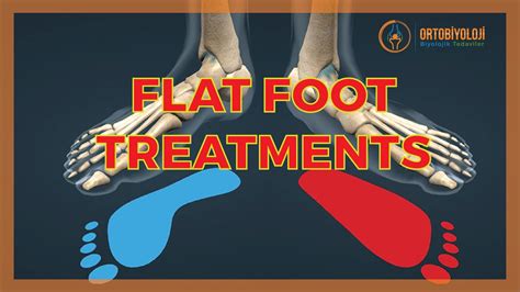 Flat Foot Treatments Youtube