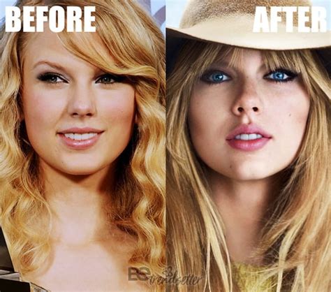 Taylor Swift Plastic Surgery Mystery Solved