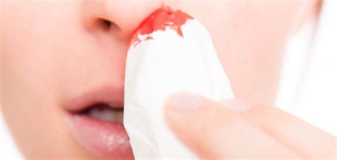 Przyczyny krwotoków z nosa Civilmed