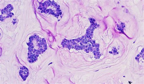 Pathology Outlines Primary Cutaneous Mucinous Carcinoma