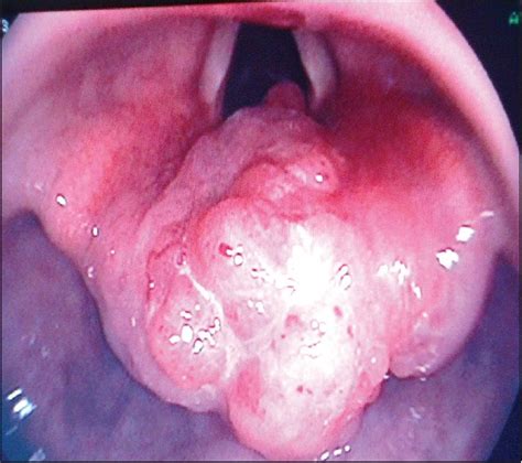 A lump in the neck: Primary small cell carcinoma of the larynx Sharma JD ...