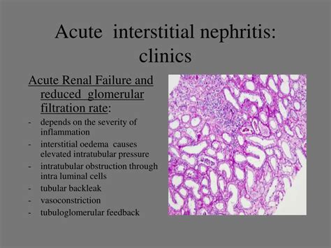 Ppt Acute And Chronic Interstitial Nephritis Powerpoint Presentation