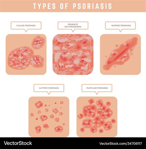 Psoriasis Types Skin Problems Close Up Medical Vector Image