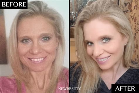 how this 47 year old woman completely transformed her smile from home newbeauty