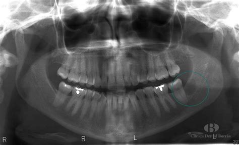 Quistes Maxilares Clínica Dental Borrás