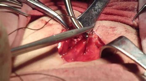 Indirect Inguinal Hernia Repair With Prolene Mesh Youtube