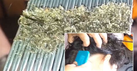 Is This The Worst Case Of Head Lice Ever Video Shows Girl Infested With Hundreds Of Nits