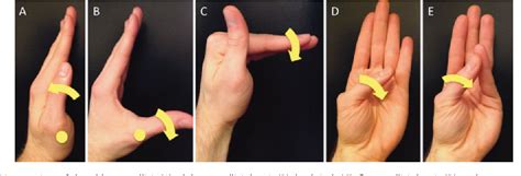 Figure 3 From Differentiating C8t1 Radiculopathy From Ulnar Neuropathy