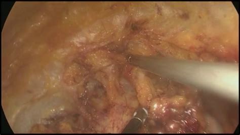 Asvide Surgical Technique Of Video Endoscopic Radical Inguinal Lymph