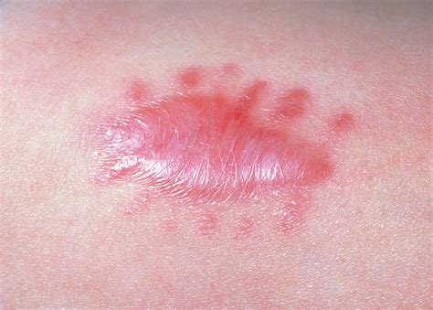 Close Up Of A Keloid Scar Developed After Surgery Photograph By Science